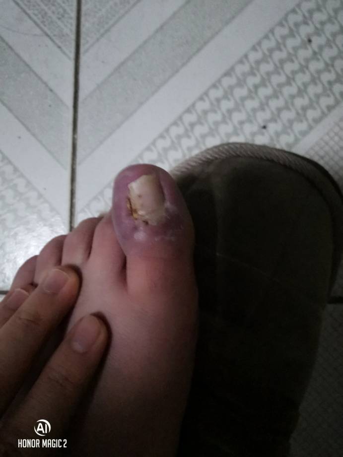 关于灰熊JJJ正式接受脚趾手术三个月后重新评估的信息
